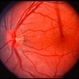 Possible CMV Retinitis with Frosted Branch Angiitis